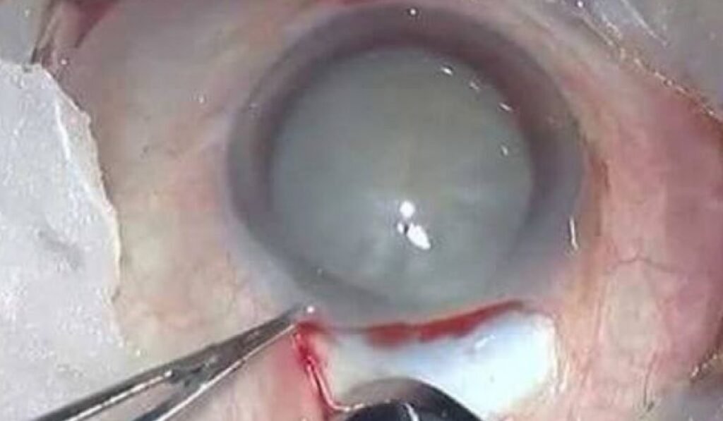 Cataract Surgery