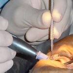 Cataract Surgery