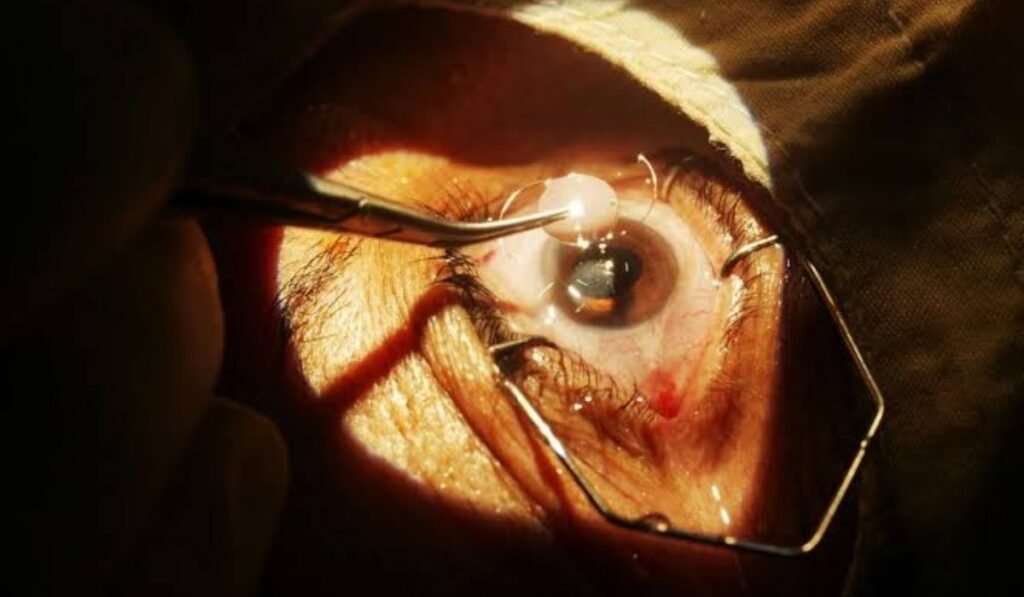 Cataract Surgery