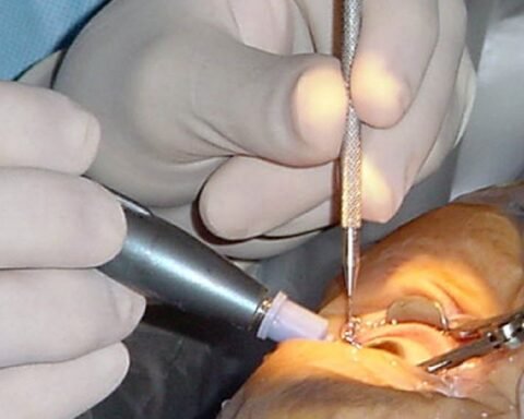 Cataract Surgery