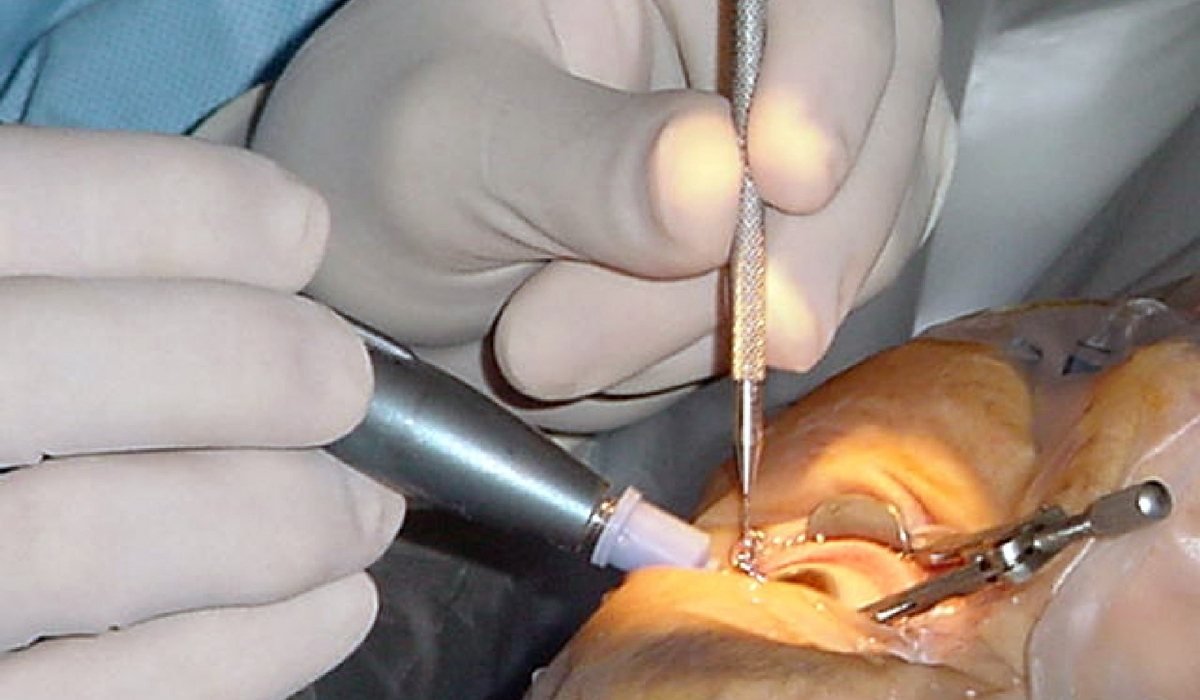 Cataract Surgery