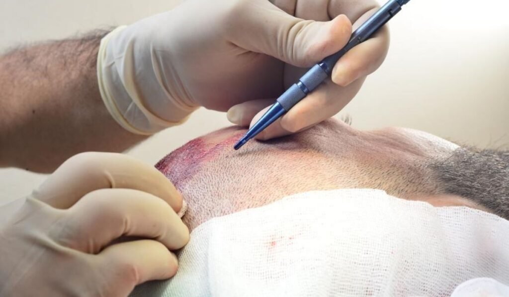 Turkey Hair Transplant