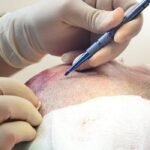 Turkey Hair Transplant