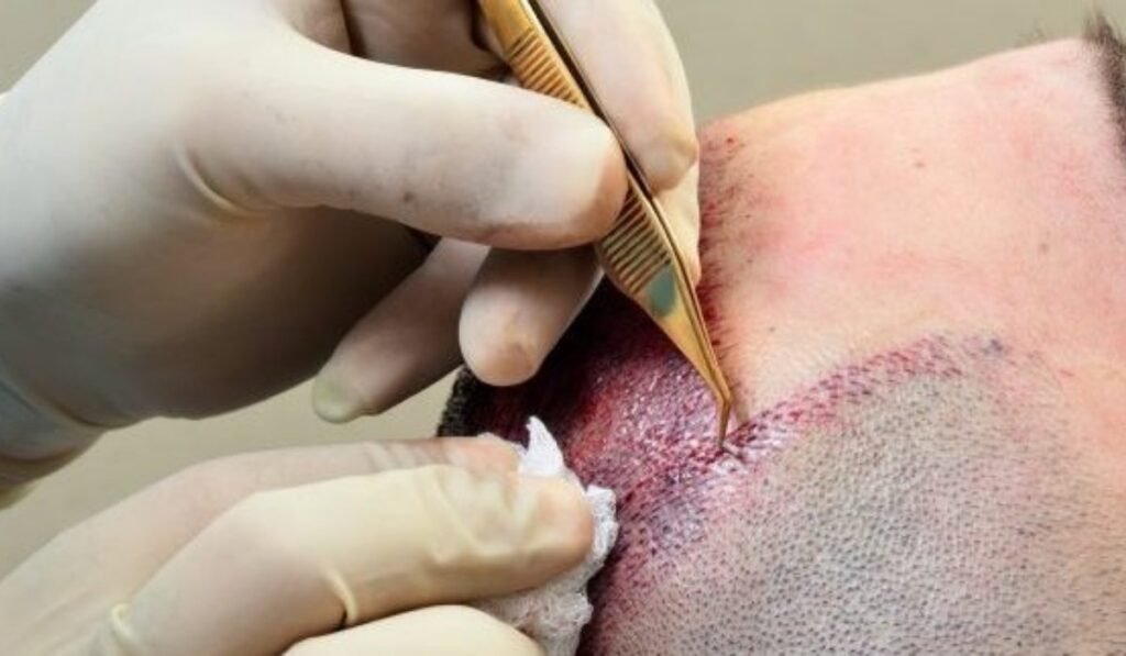 Turkey Hair Transplant