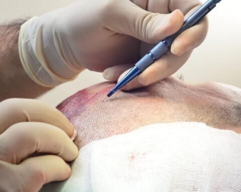 Turkey Hair Transplant