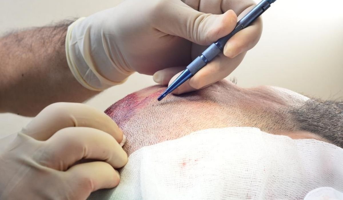 Turkey Hair Transplant